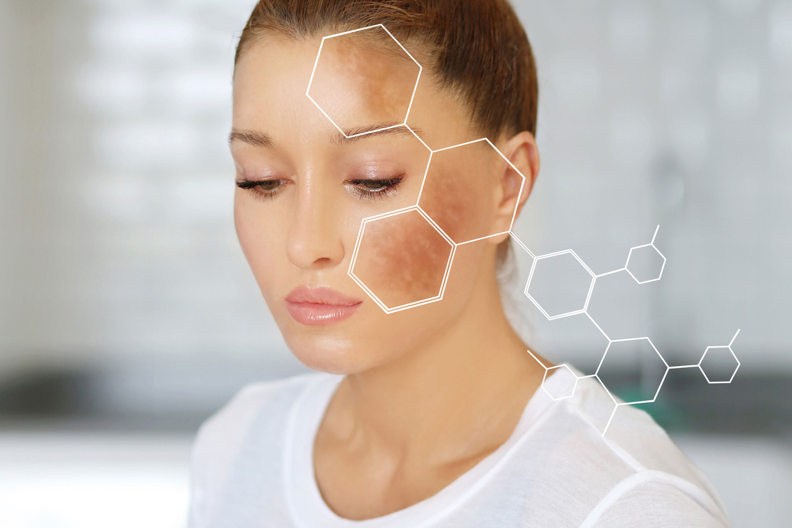 woman with melasma